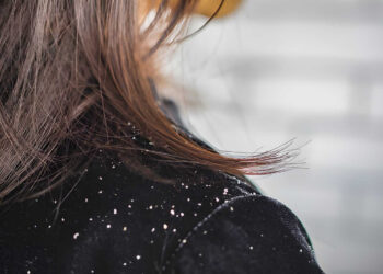 Woman hair with dandruff falling on shoulders