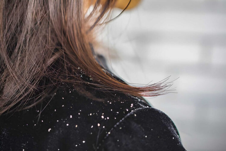 Woman hair with dandruff falling on shoulders