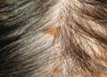 Hidden scalp buildup
