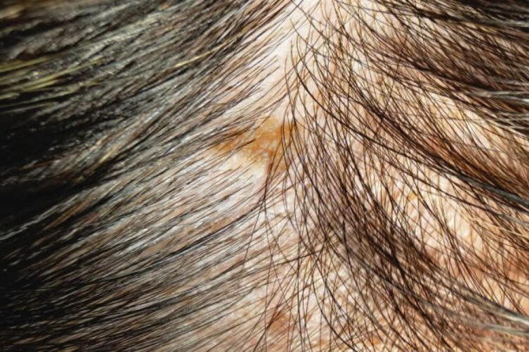 Hidden scalp buildup