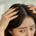 Woman Worried about Hair Loss and Dandruff