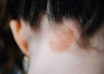 a girl's scalp with eczema