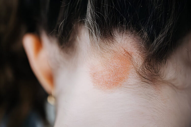 a girl's scalp with eczema
