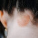 a girl's scalp with eczema