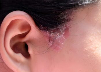 Close up sideburns girl has ringworm fungal lesions