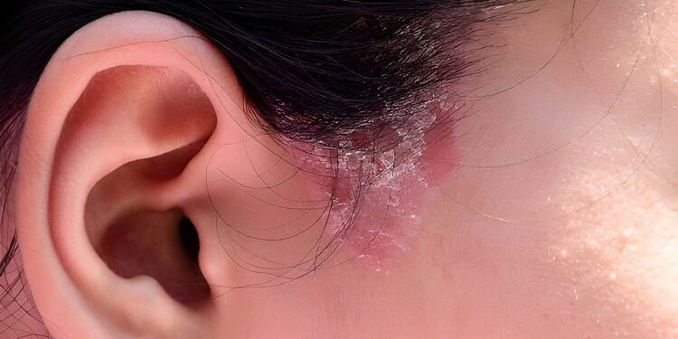Close up sideburns girl has ringworm fungal lesions