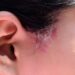 Close up sideburns girl has ringworm fungal lesions