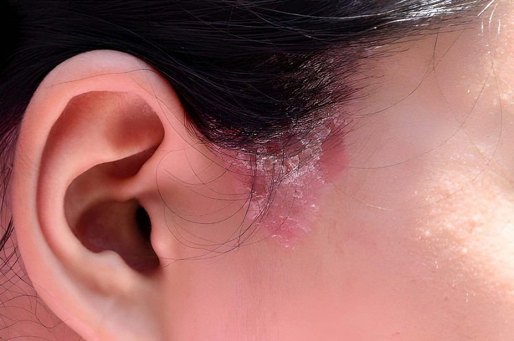 Close up sideburns girl has ringworm fungal lesions