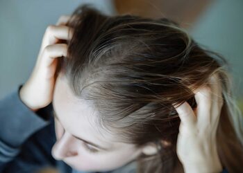 woman worried of scalp dandruff