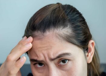 woman worrying about her forehead with part of her thin hair