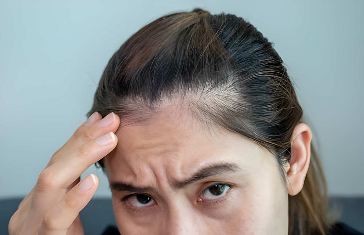 woman worrying about her forehead with part of her thin hair