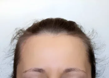 young woman's head with growing protruding hair