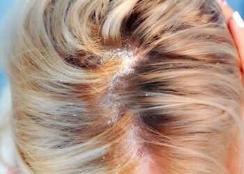 Dandruff in the hair and scalp