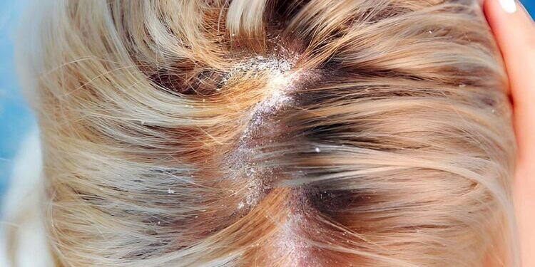 Dandruff in the hair and scalp