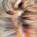 Dandruff in the hair and scalp