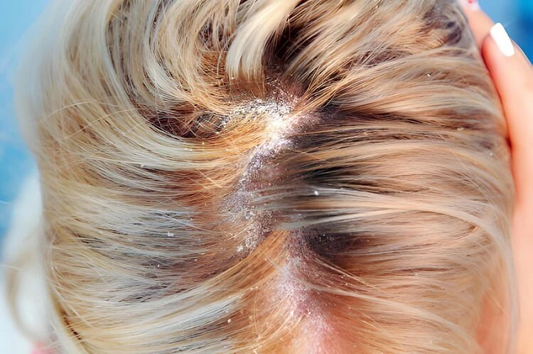 Dandruff in the hair and scalp
