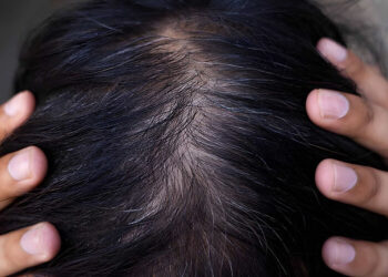 Hair Crown Thinning