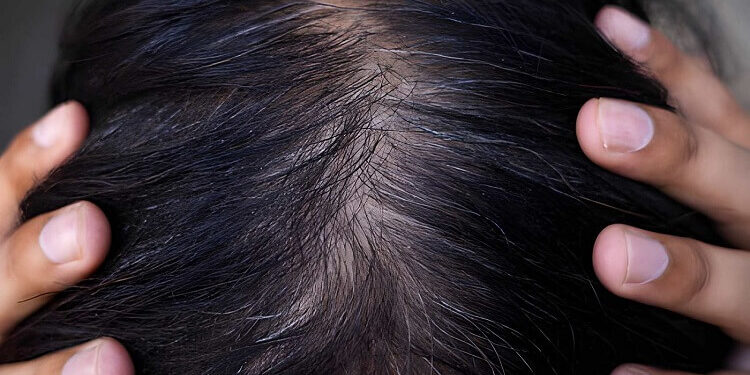 Hair Crown Thinning