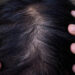 Hair Crown Thinning