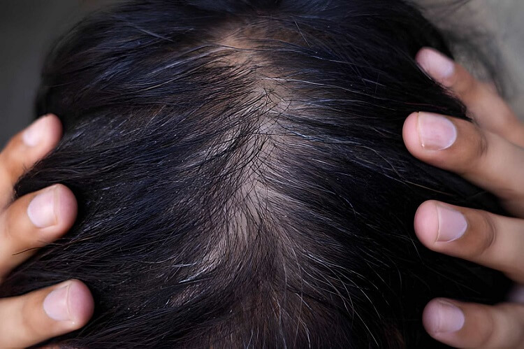 Hair Crown Thinning