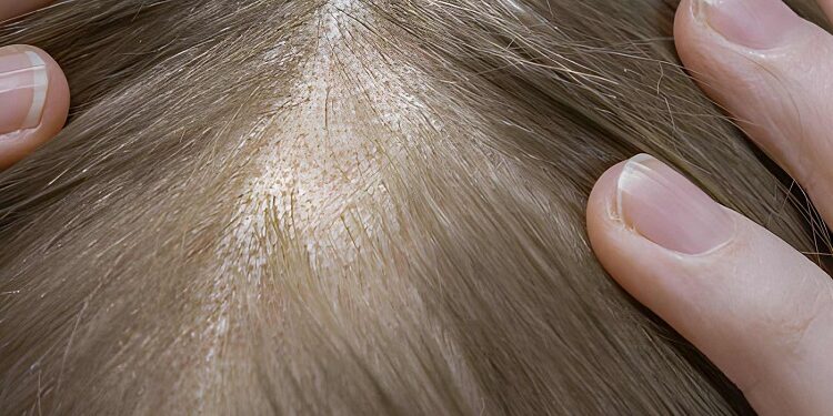 Telogen effluvium - hair loss and bald spot on a woman's head