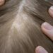 Telogen effluvium - hair loss and bald spot on a woman's head